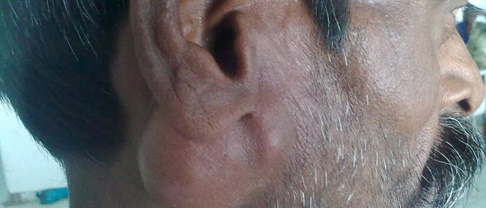 1200px-Parotid_Tumour