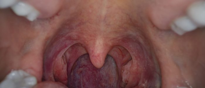 Adult woman mouth, tonsillitis, tonsil, uvula, swollen.